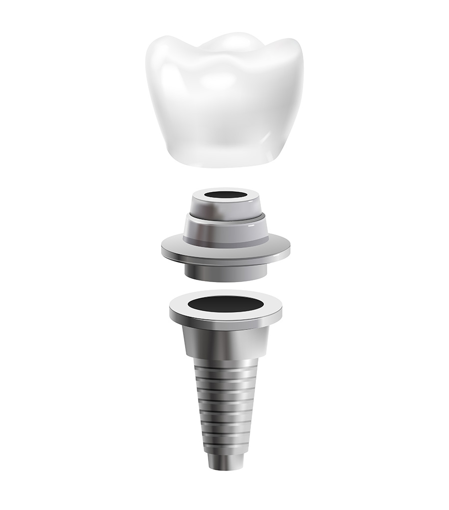 implante-dental-palencia implante-dental-palencia